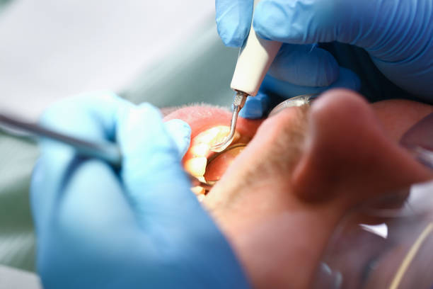 Best Emergency Dentist for Knocked-Out Tooth in Leavenworth, WA